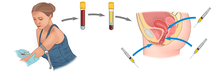 Плазмолифтинг в гинекологии Киев