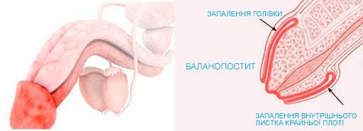 Баланопостит