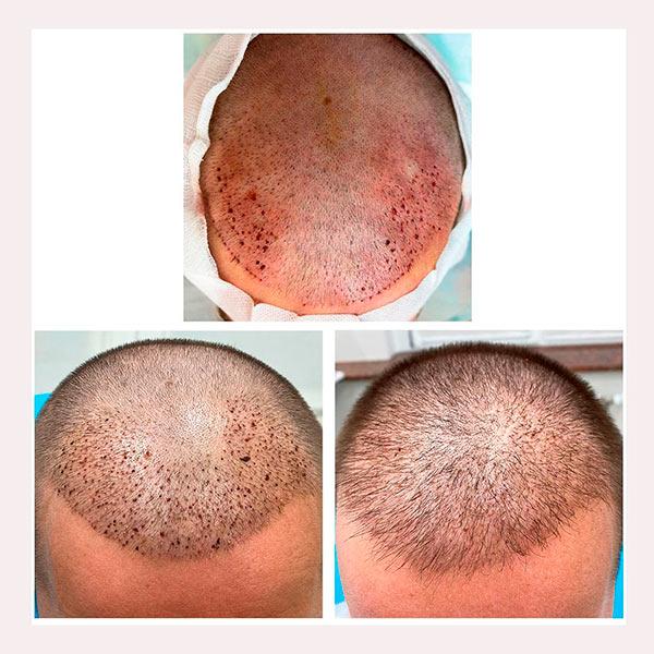 Результат после пересадки волос