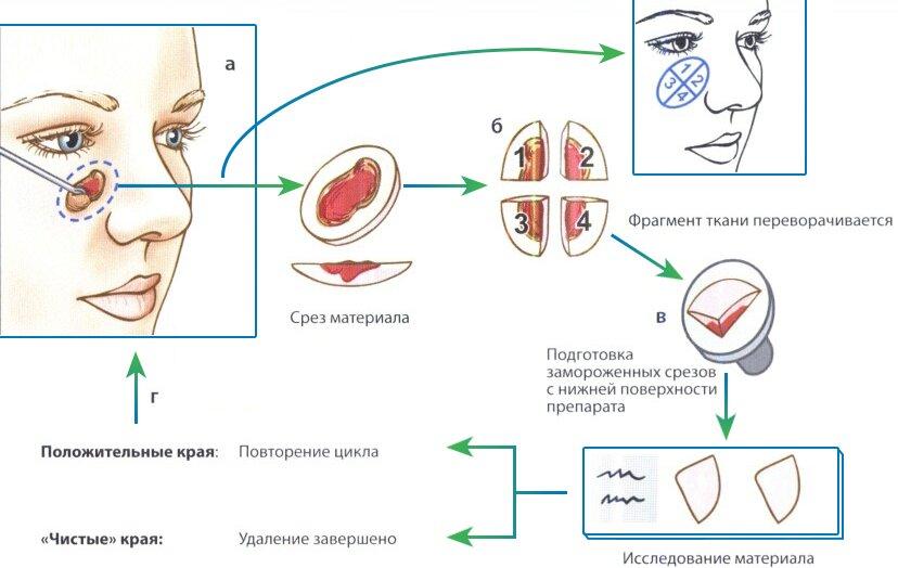 Хирургия MOSH при злокачественных образованиях кожи Хирургия MOSH при злокачественных образованиях кожи