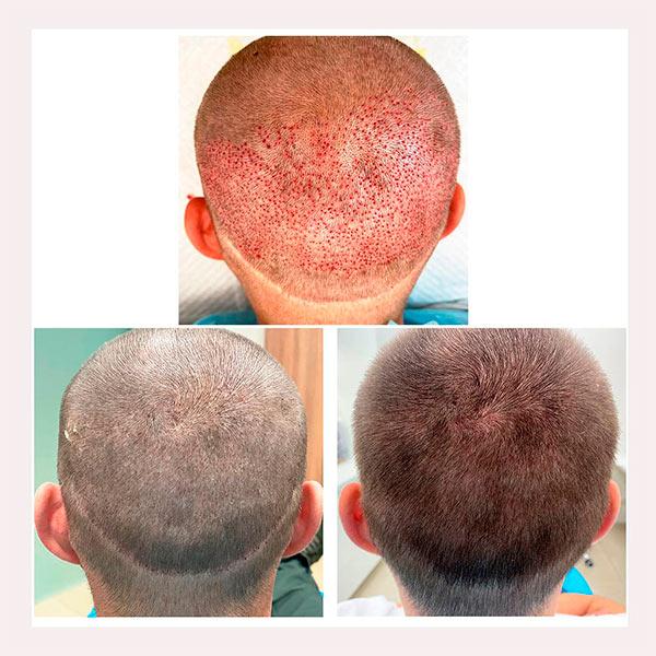 Результат после пересадки волос