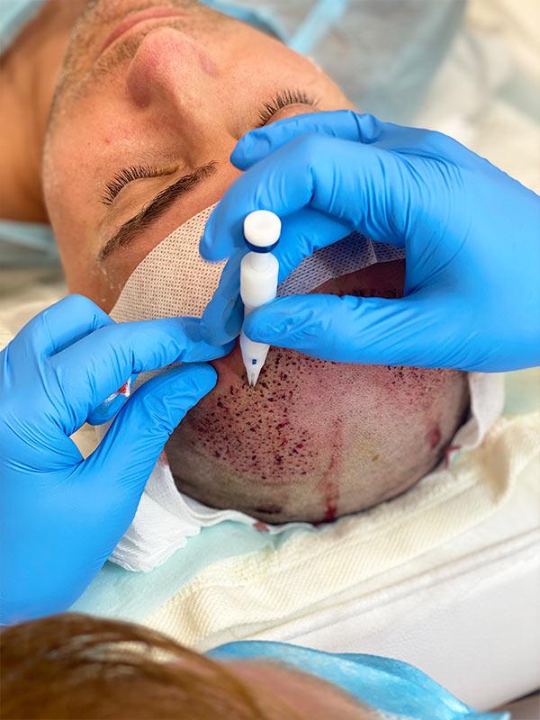 Пересадка волос Киев