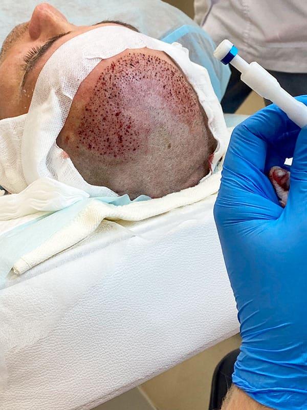 Пересадка волос Киев