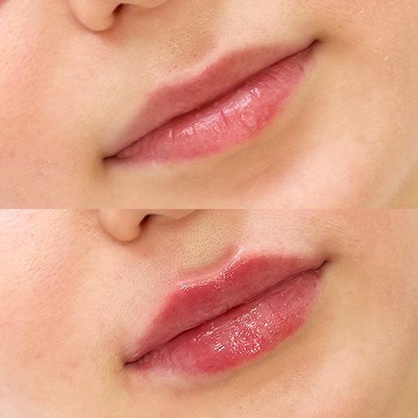 Контурна пластика губ - косметолог Київ