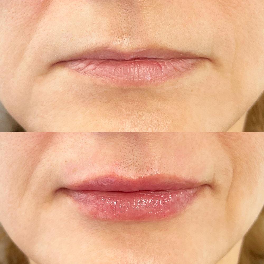 Контурная пластика губ Киев