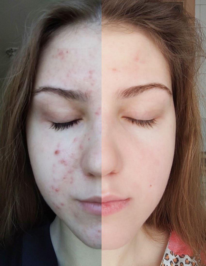 Лікування акне у підлітків Київ