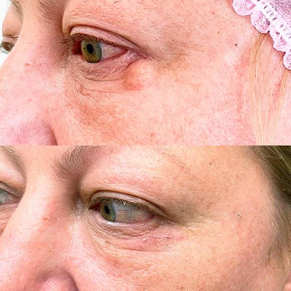 Хирургическое, лазерное, радиоволновое удаление атеромы Киев