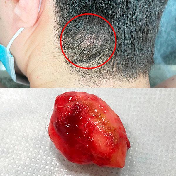 Видалення атером на голові Київ Видалення атером на голові Київ