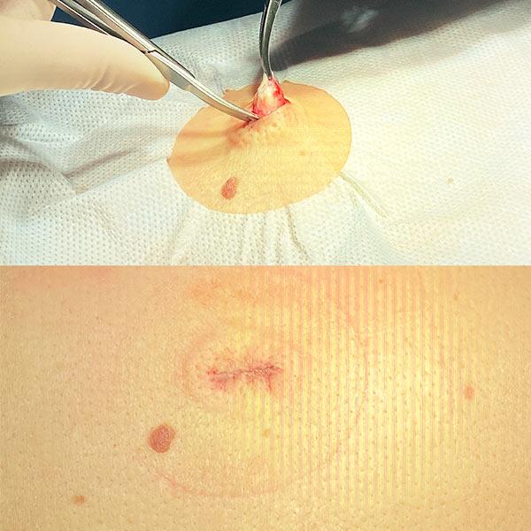 Видалення атероми Київ Видалення атероми Київ