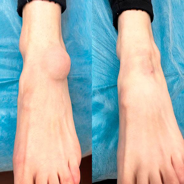 Хірургічне, лазерне, радіохвильове видалення атероми Київ