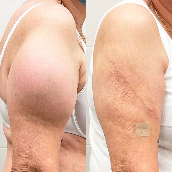 Хірургічне, лазерне, радіохвильове видалення атероми Київ