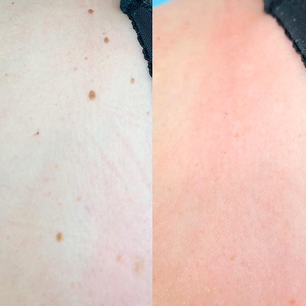 Видалення папілом лазером радіохвилею Київ