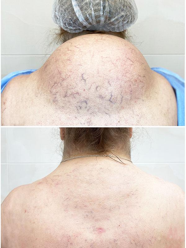 Результат до после липосакции холки 