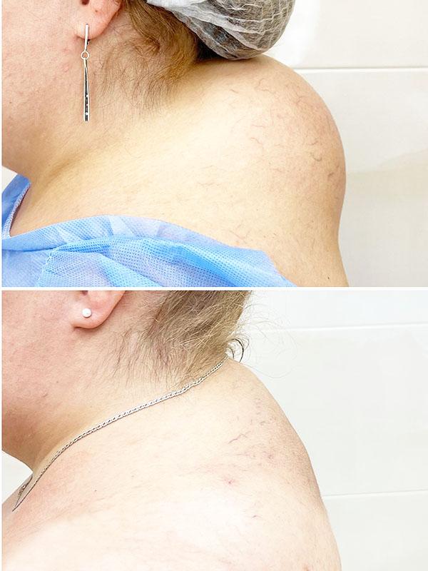 Результат до после липосакции холки