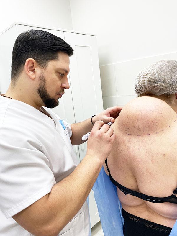 Удаление вдовьего горба Киев