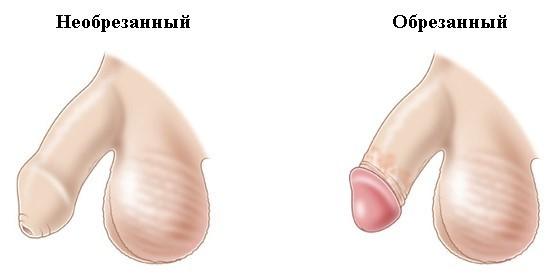 Обрезание крайней плоти у мужчин
