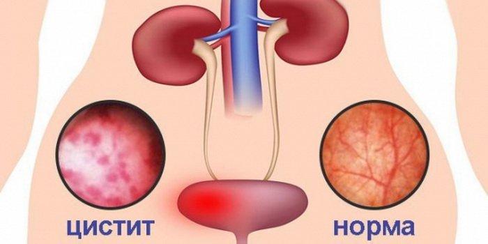Лікування циститу Київ