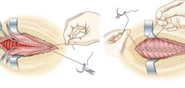 Гіменопластика Київ