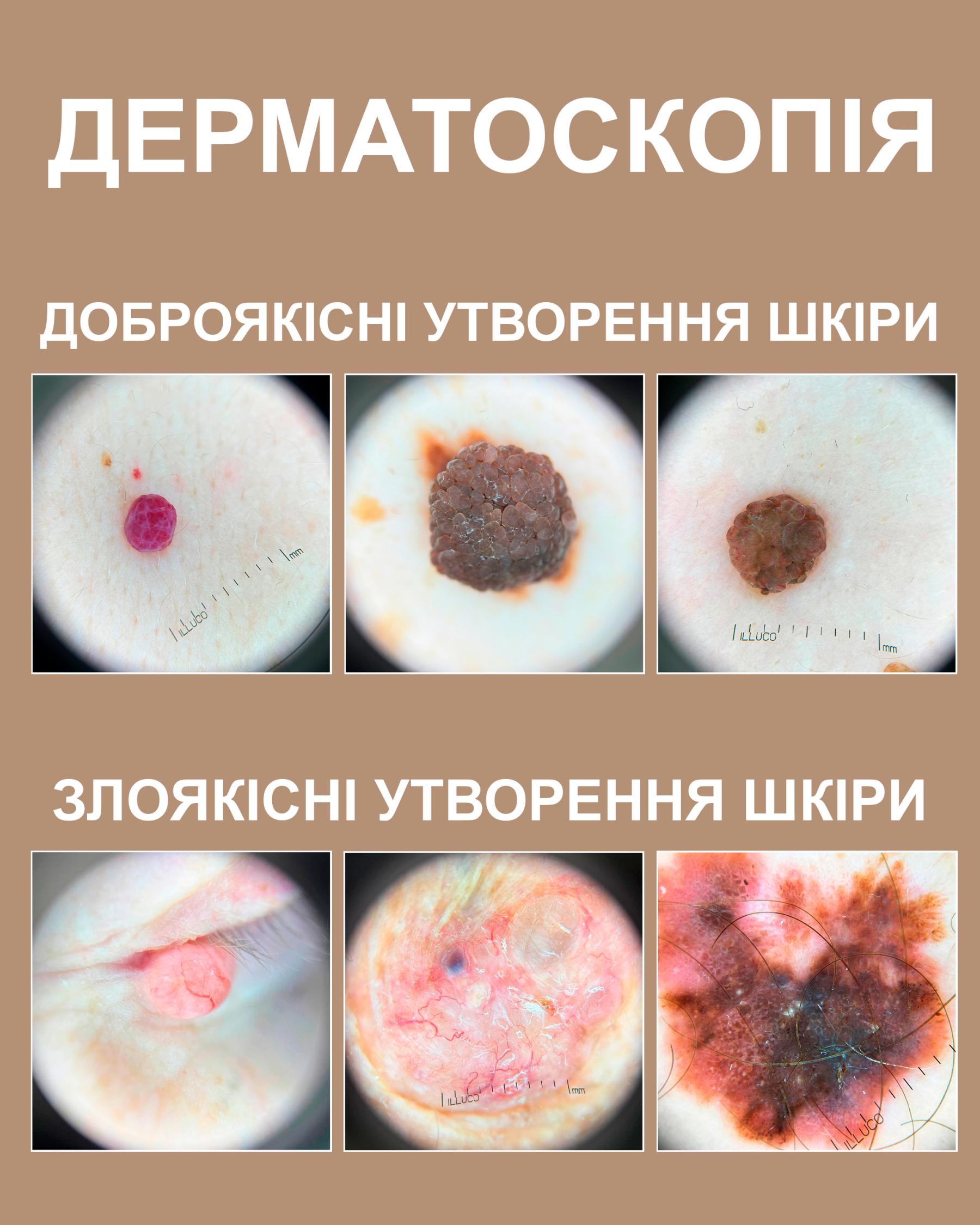 Дерматоскопія родимок Київ