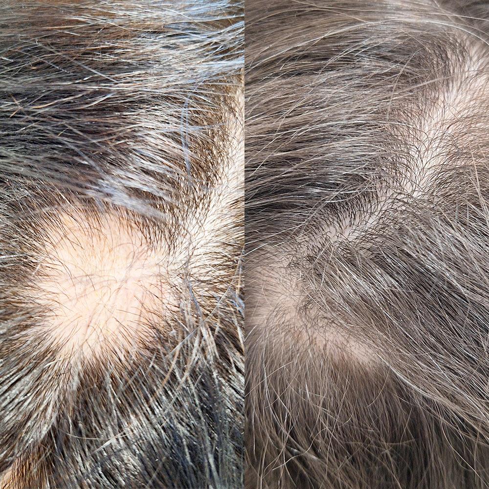 Лікування вогнищевої алопеції Київ