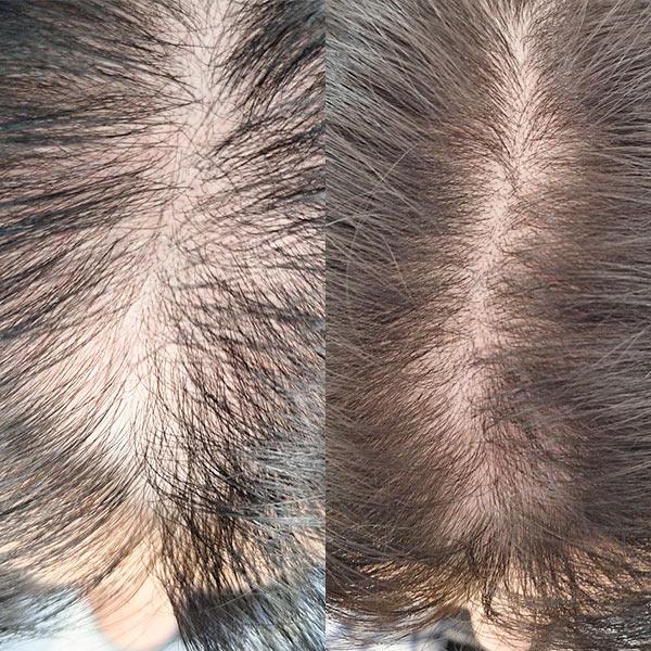 Лікування андрогенної алопеції в жінок Київ