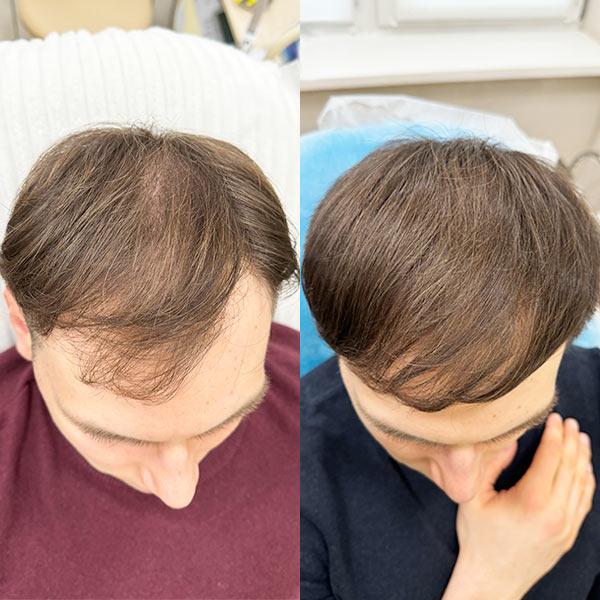 Лікування андрогенної алопеції у чоловіків Київ