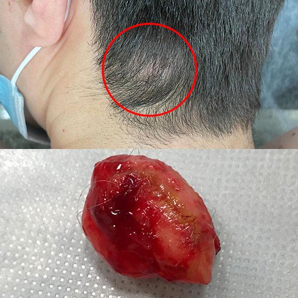 Видалення атероми Київ