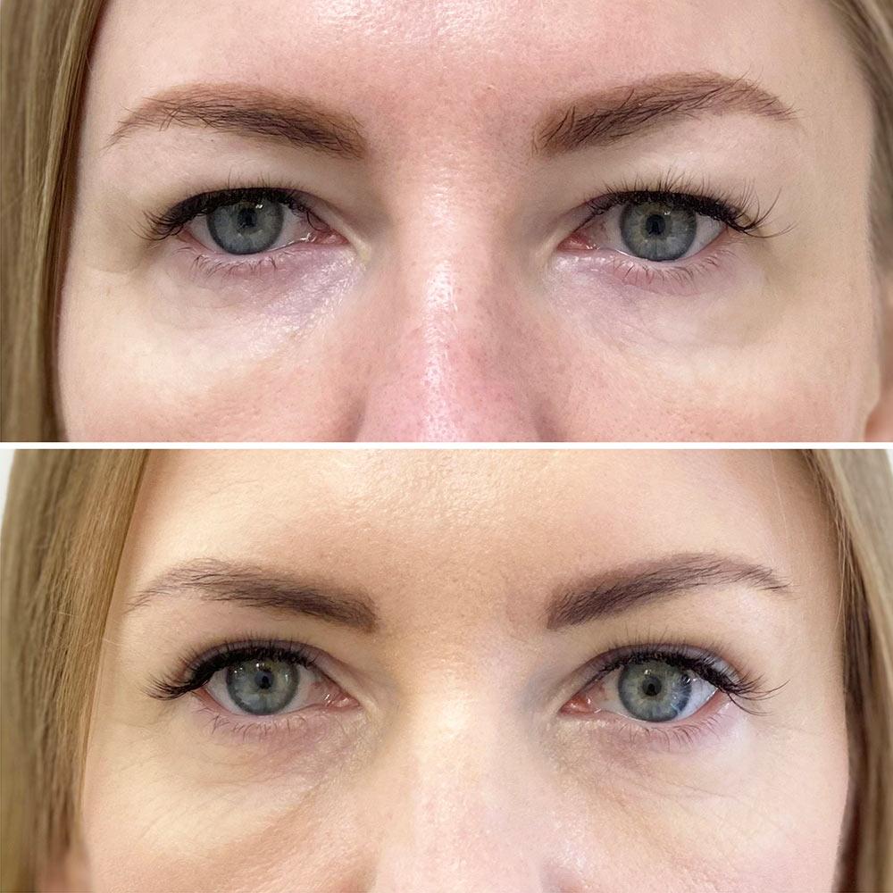 Блефаропластика у SENSAVI Київ