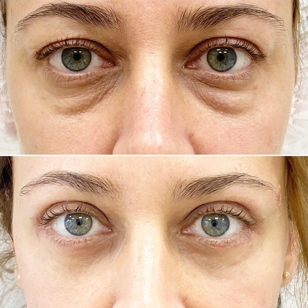 Блефаропластика в SENSAVI Киев Блефаропластика в SENSAVI Киев