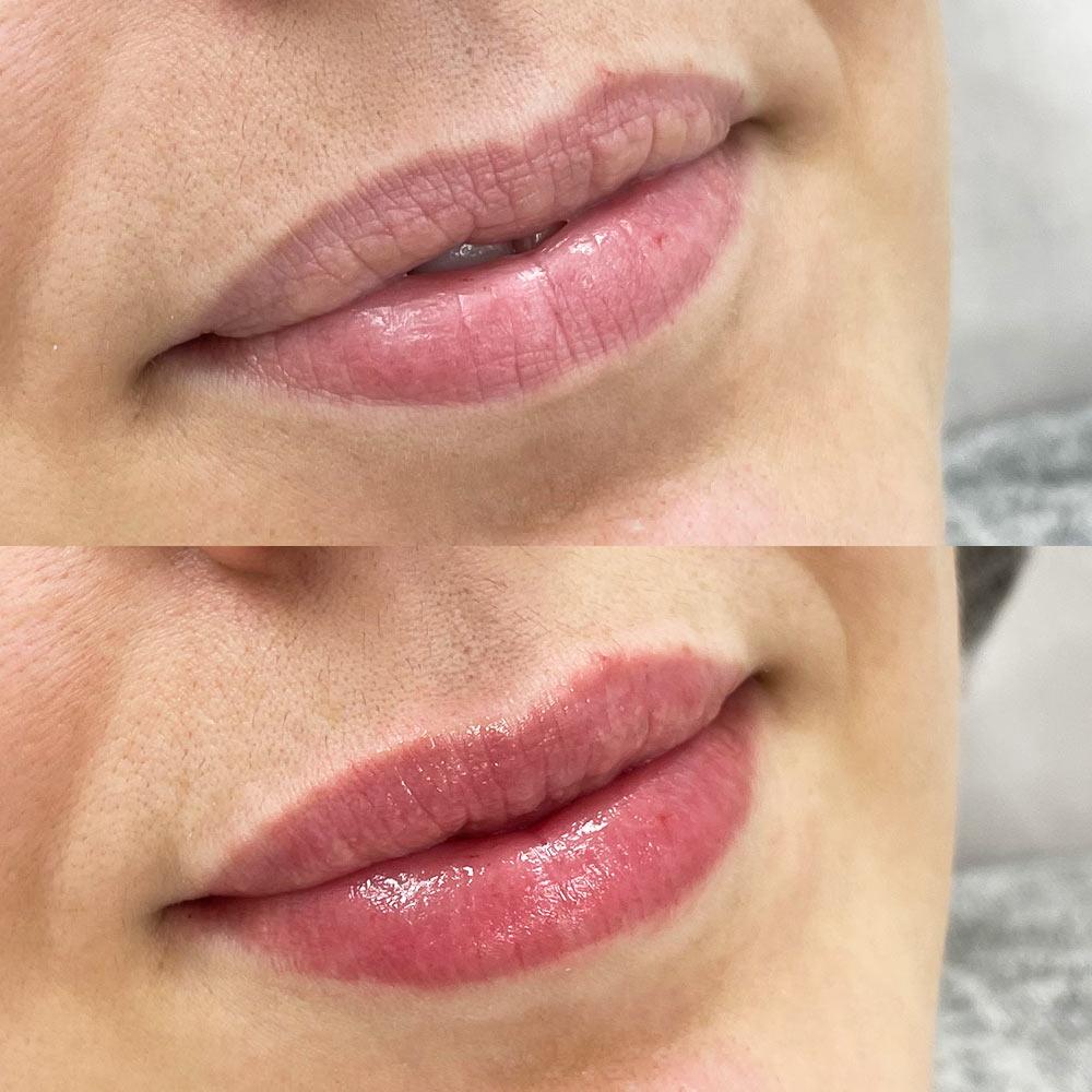 Контурная пластика губ в SENSAVI Киев