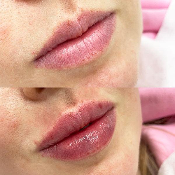 Контурная пластика губ в SENSAVI Киев