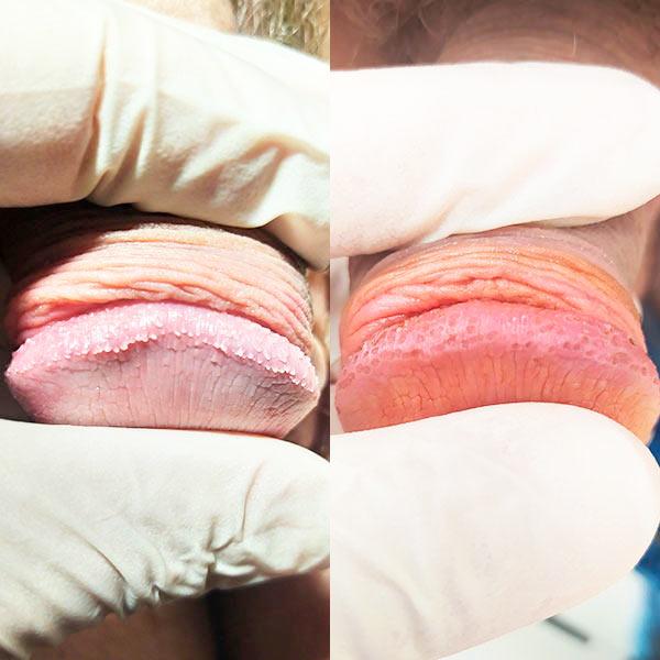 Удаление перламутровых папул Киев