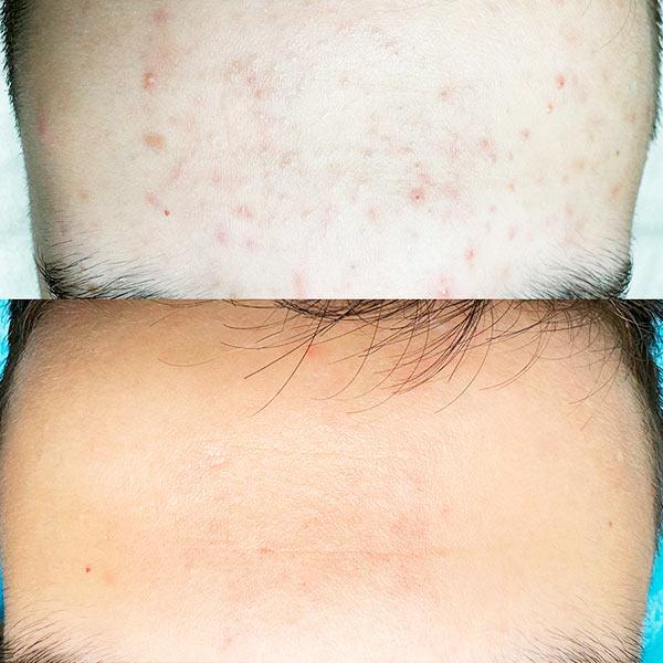 Лечение акне Киев