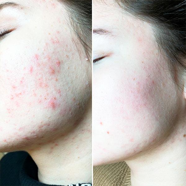 Лікування акне Київ