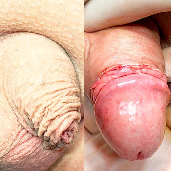 Циркумцизия Киев