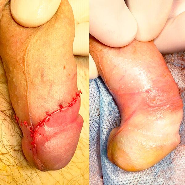 Обрізання крайньої плоті Київ