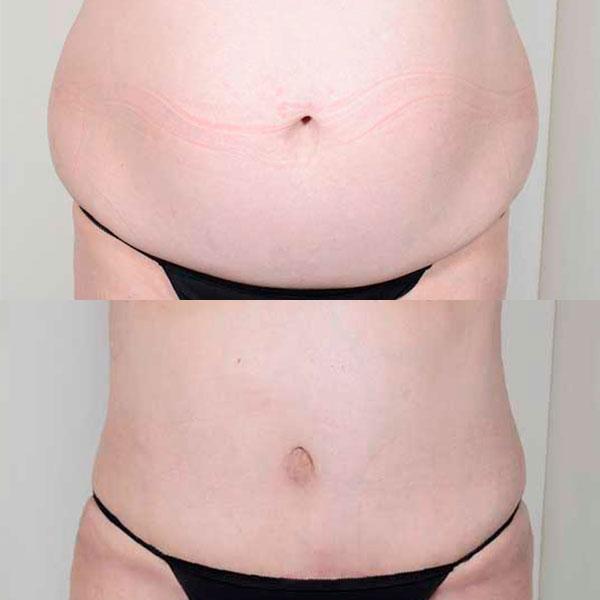Абдоминопластика Киев