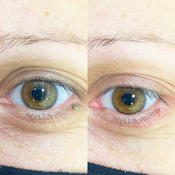 Удаление папиллом Киев