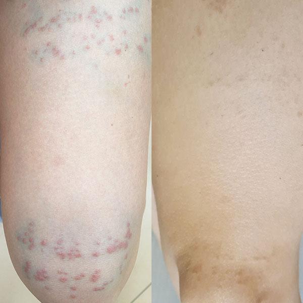 Лечение контактного дерматита Киев