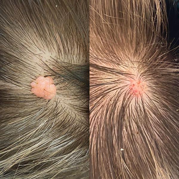 Удаление родинки Киев