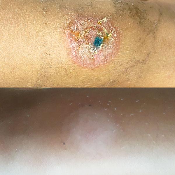 Пиодермия - дерматолог Киев