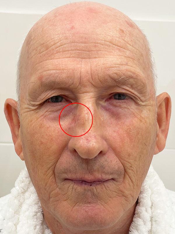 Удаление базалиомы МОС Киев Удаление базалиомы МОС Киев