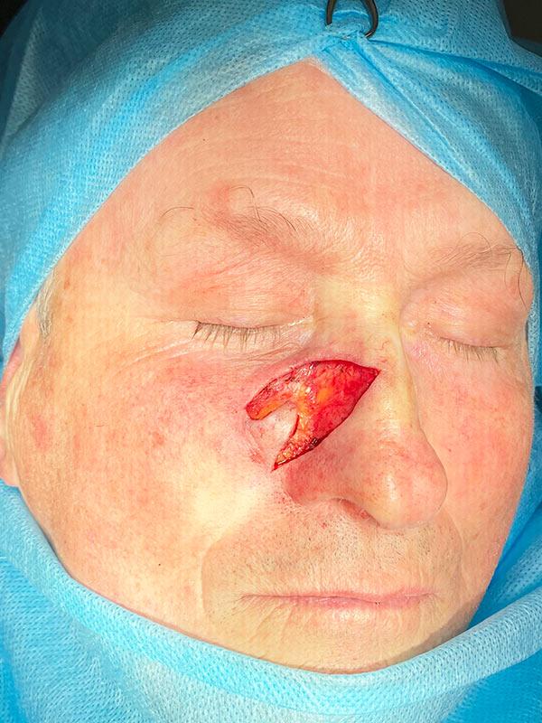 Удаление базалиомы MOSH Киев Удаление базалиомы MOSH Киев