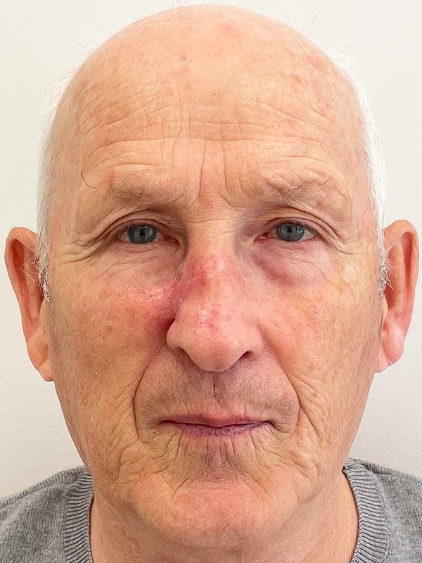 Хирургическое удаление рака кожи методом МОС Киев Хирургическое удаление рака кожи методом МОС Киев