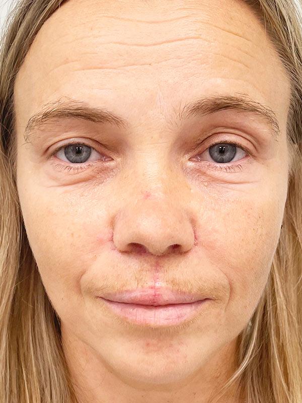 Удаление по MOSH Киев Удаление по MOSH Киев