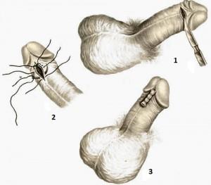Френулотомия Киев - операция на короткой уздечке