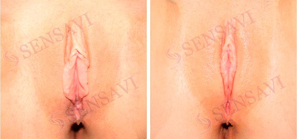 Лабіопластика Київ