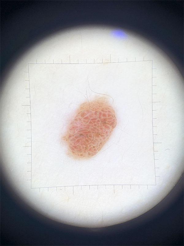 Дерматоскопия - дерматолог Киев