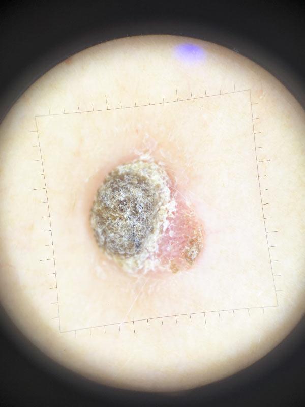 Дерматоскопия Киев - диагностика кожи