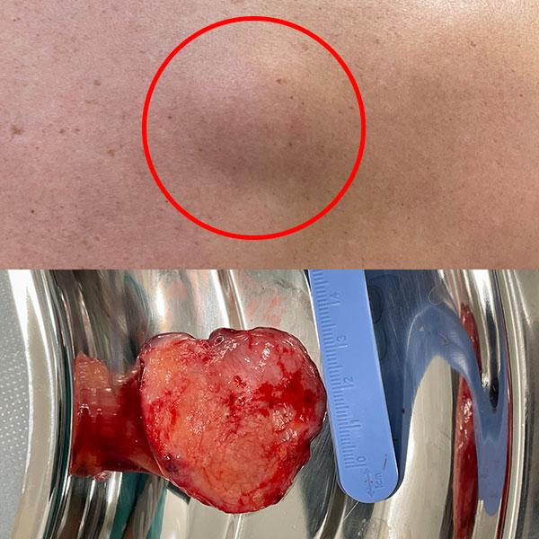 Видалення ліпоми Київ